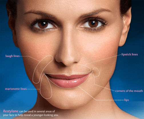 What is Restylane facial filler used for? 