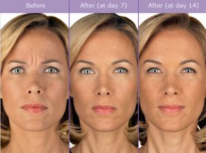 Botox vs Xeomin | Dallas Surgeon | Plano Anti-Aging Injectables