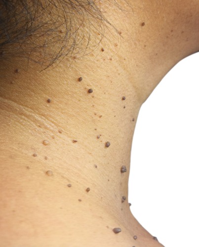 skin tag and mole removal skin tag mole remover moles and skin tags