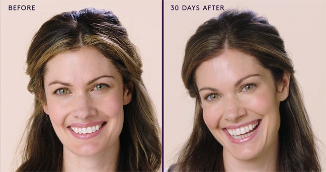 Botox to Remove Wrinkles Around The Eyes