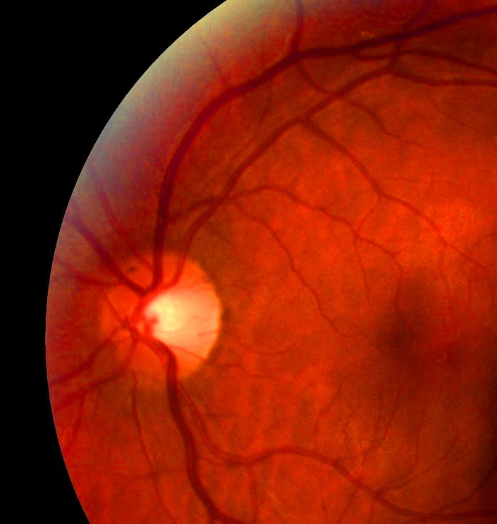 Optic Nerve Surgery Oculoplastic Surgeon Dallas, Plano