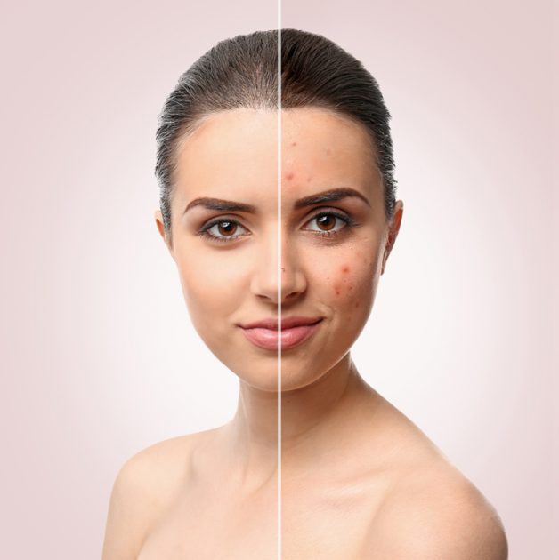 Chemical Peels Help Rejuvenate Your Face