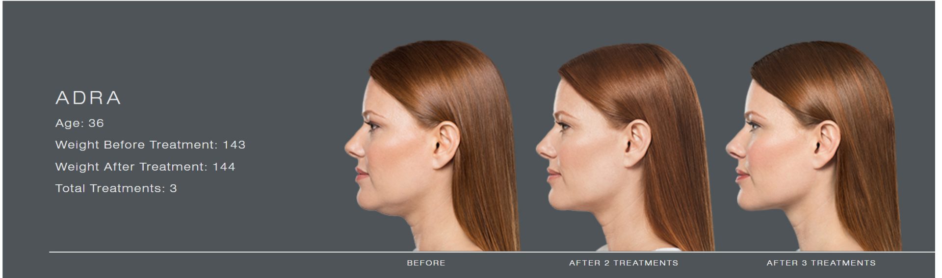 Kybella Chin Fat Reduction Before And After Photos