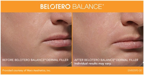 Belotero Dermal Filler (Under Eyes, Wrinkles) Before And After Photos
