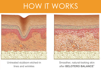 How Much Does Belotero Filler (Under Eyes, Wrinkles) Cost?