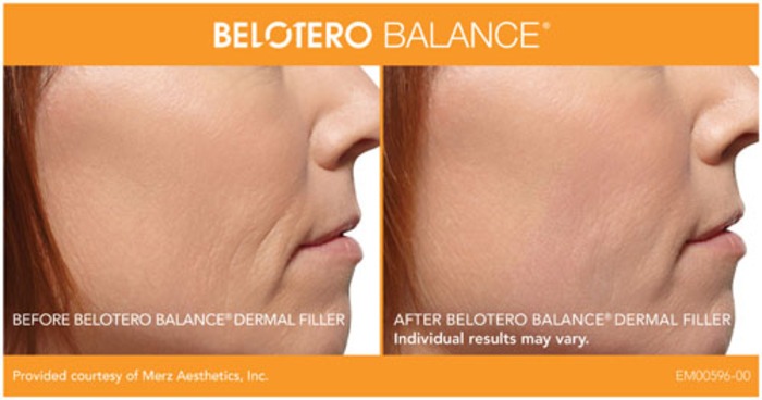 Belotero Dermal Filler (Under Eyes, Wrinkles) Before And After Photos