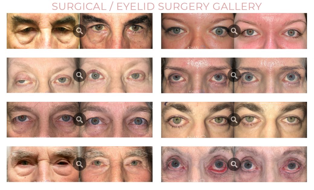 Lower Eyelid Plastic Surgery Before And After Photos