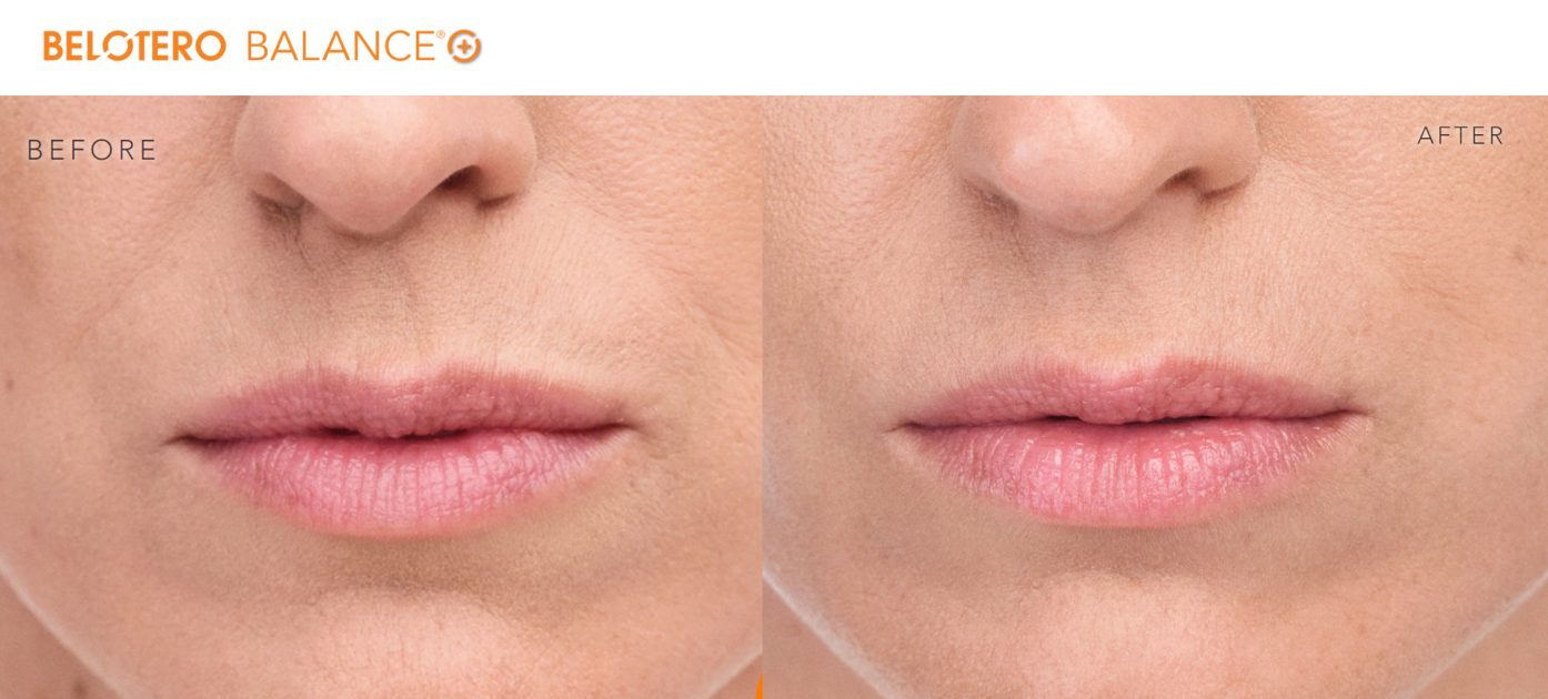 Belotero Balance Dermal Filler