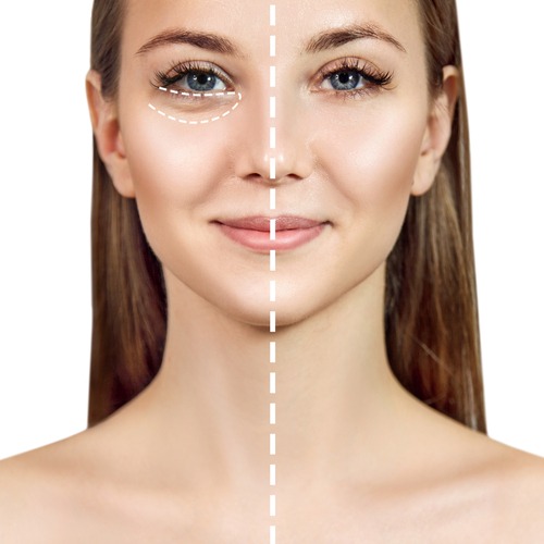 Eye Fillers Are Common For Alleviating Darkness Under The Eyes