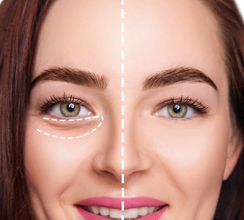 Treatments For Bags Under The Eyes - Dallas