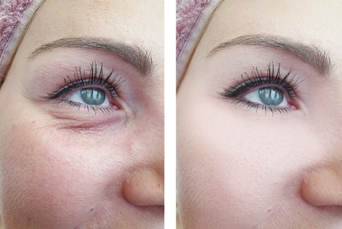 Treat Aged And Damaged Skin Around And Under The Eyes With Laser Skin Resurfacing