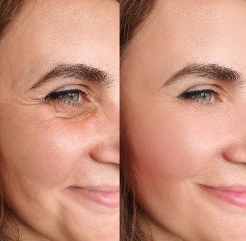 Tighten Loose Sagging Skin Under Eyes